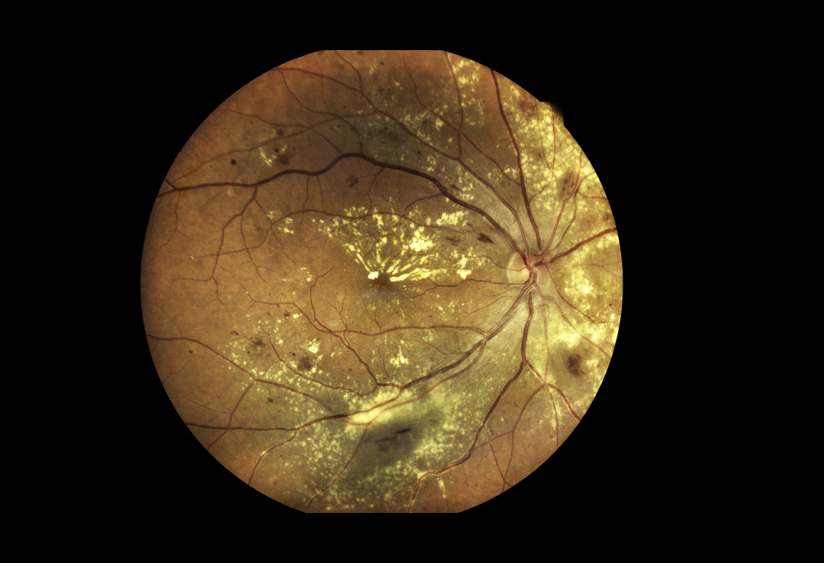 Combination Therapy to Treat Wet Type Age-Related Macular Degeneration