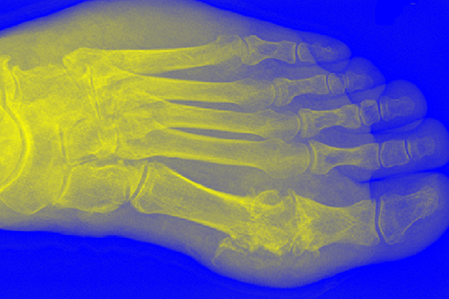 Novel Treatment for Gout and Hyperuricemia