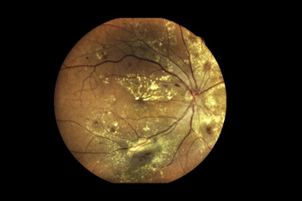 Combination Therapy to Treat Wet Type Age-Related Macular Degeneration