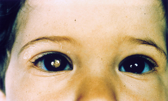 Evaluation of Ophthalmic Disease from Cell Free DNA in the Aqueous Humor