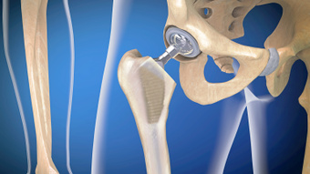 Orthopedic Implant Coating